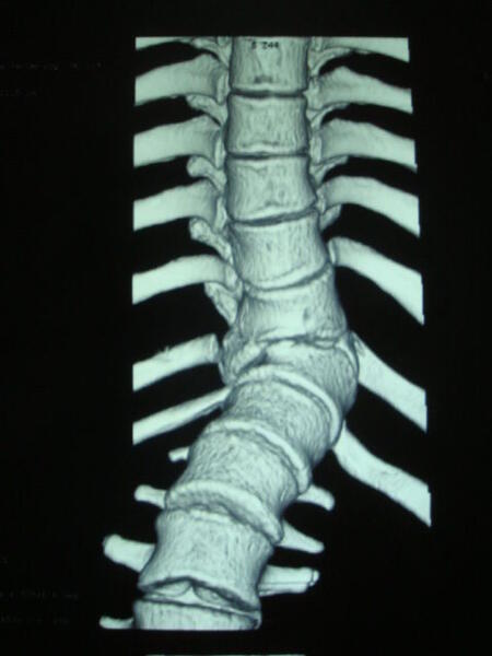 胸椎半椎体图片