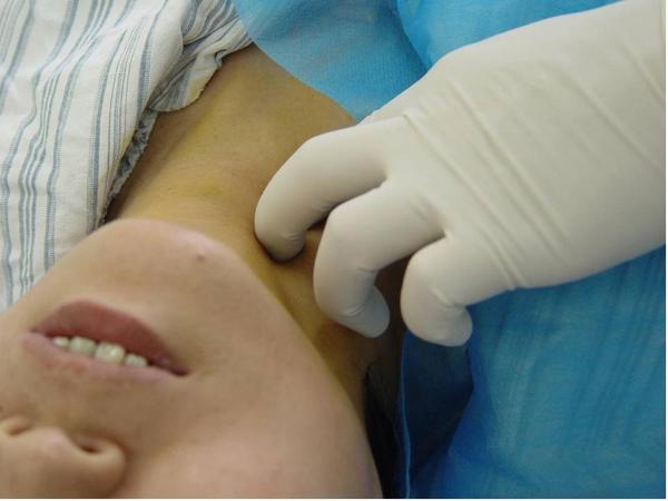 星状神经节阻滞治疗过敏性鼻炎