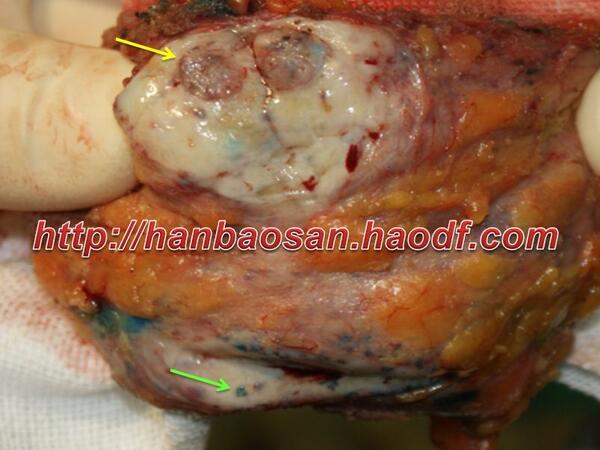 乳腺导管瘤图片