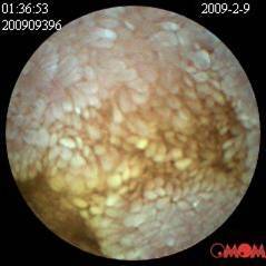 小肠淋巴管扩张症