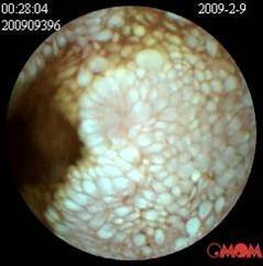 小肠淋巴管扩张症