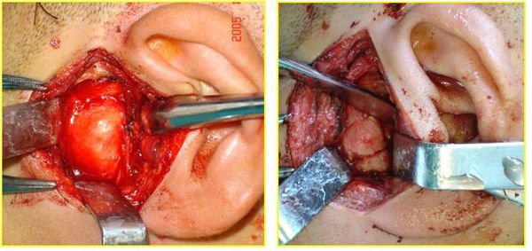 髁突高位切除术结合正畸治疗髁突肥大