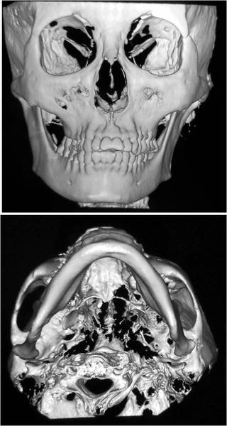 髁突高位切除术结合正畸治疗髁突肥大