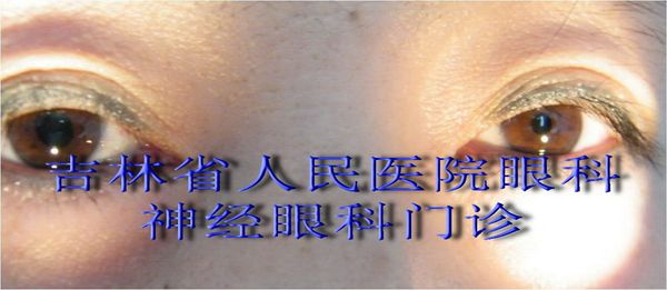 强直性瞳孔典型病例2