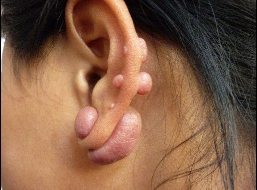 如同割韭菜一样再生的耳垂瘢痕疙瘩(山东青岛)