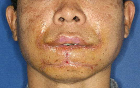 下唇癌手术后图片图片