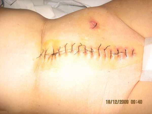 肠梗阻手术切口图图片