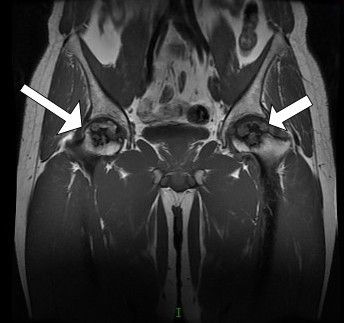 股骨头坏死mri表现图片