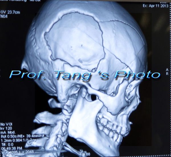 3d数字颅骨修补术的近期患者应用实例 - 好大夫在线