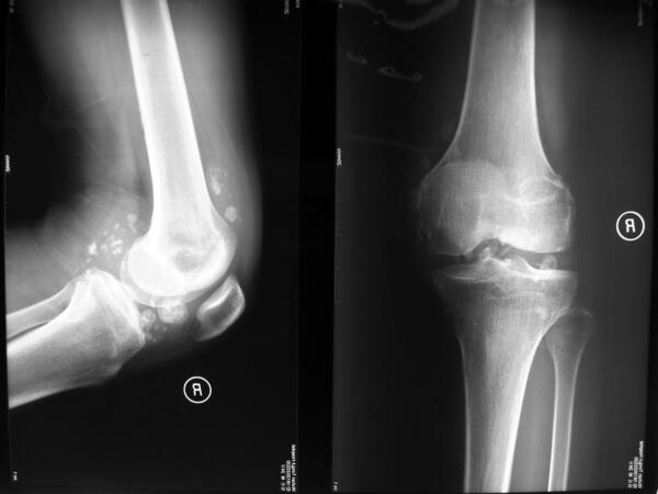 滑膜软骨瘤x光图片图片