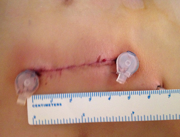 房间隔缺损个体化微创治疗