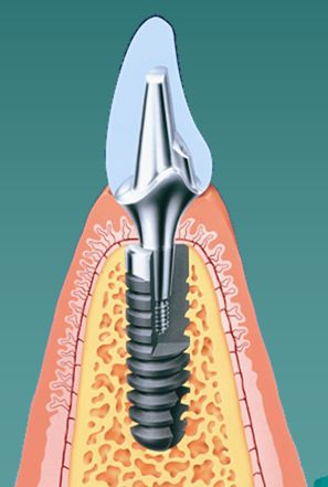 德国ankylos种植系统特点介绍