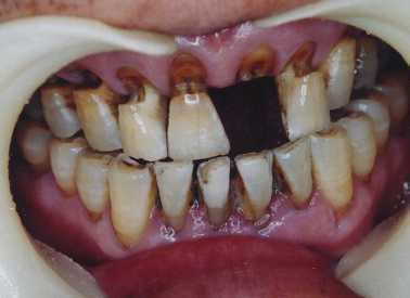 重视"正确刷牙" 不要把牙齿"锯"坏了