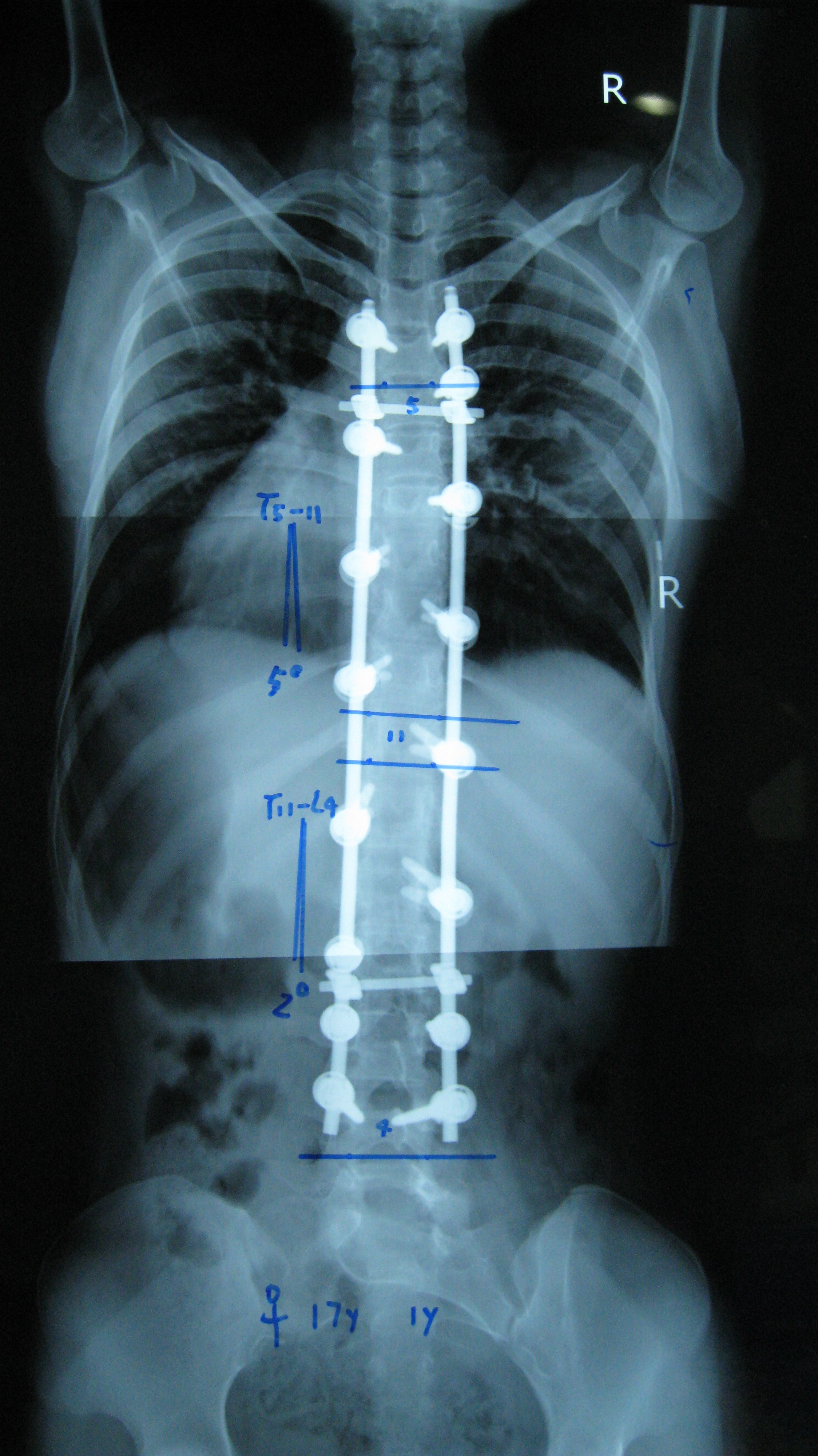 后路手术矫形治疗青少年特发性脊柱侧凸畸形(附图片资料) 