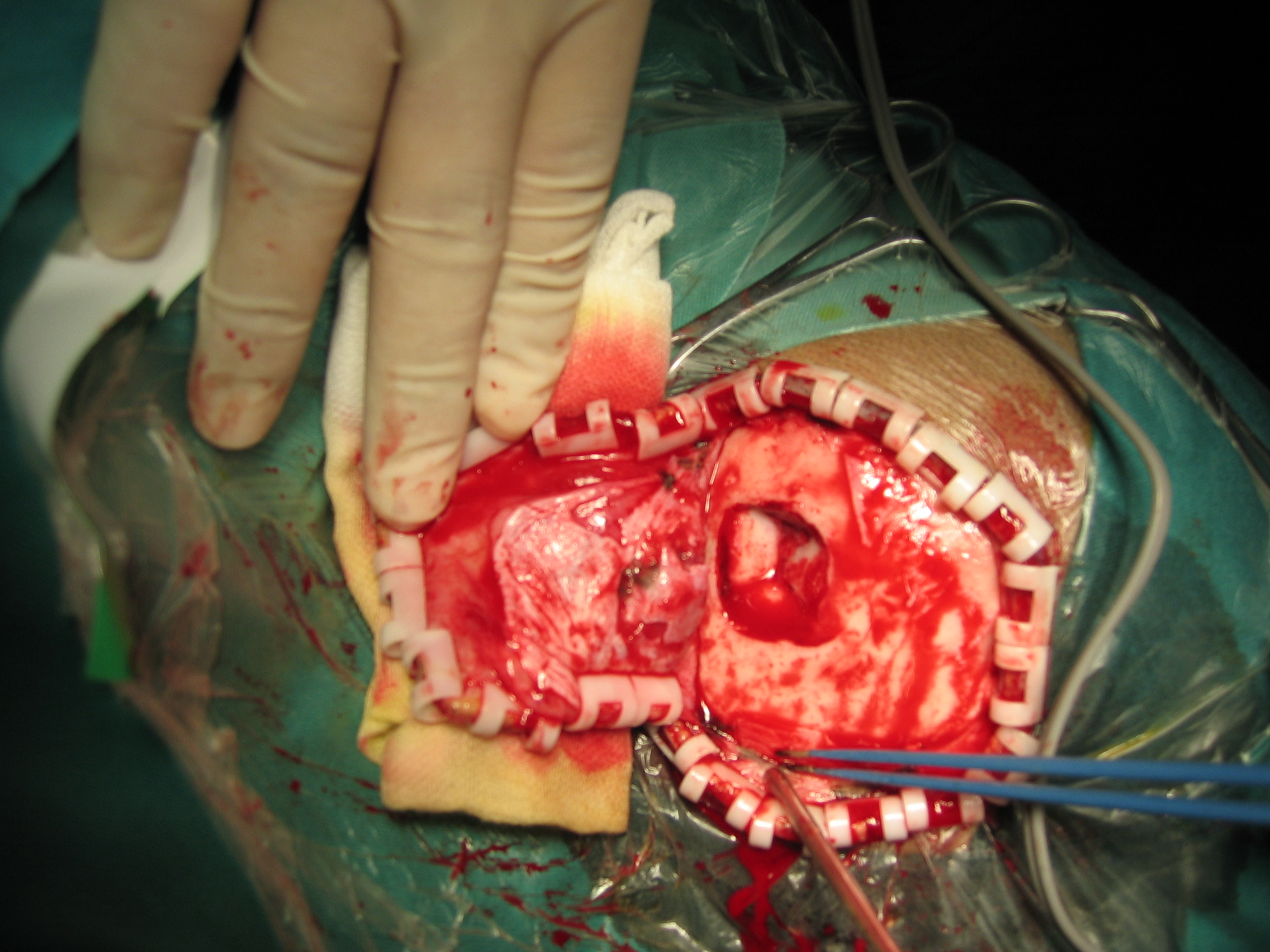 颅脑损伤-凹陷性骨折