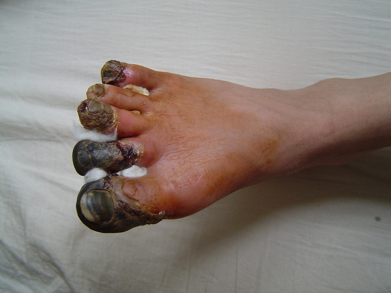 肢体动脉缺血的典型图片 - 好大夫在线