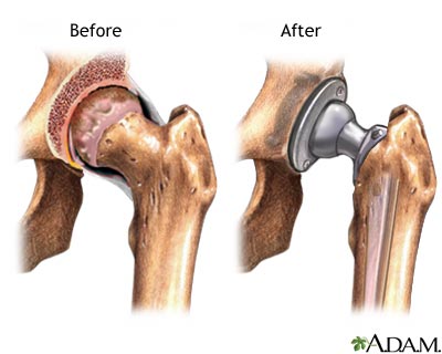 全髋关节置换手术图解