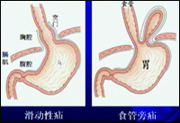 食道裂孔疝_食管裂孔疝_疾病介紹_手術_治療方法_介紹_治療方式 - 好