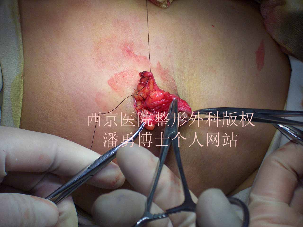 乳房下垂提升手术照片图片