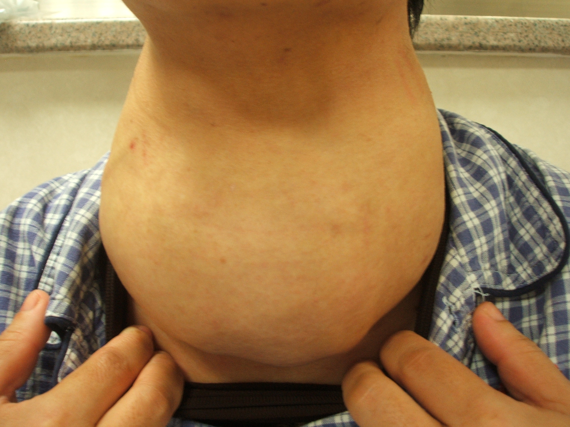 甲状旁腺瘤图片