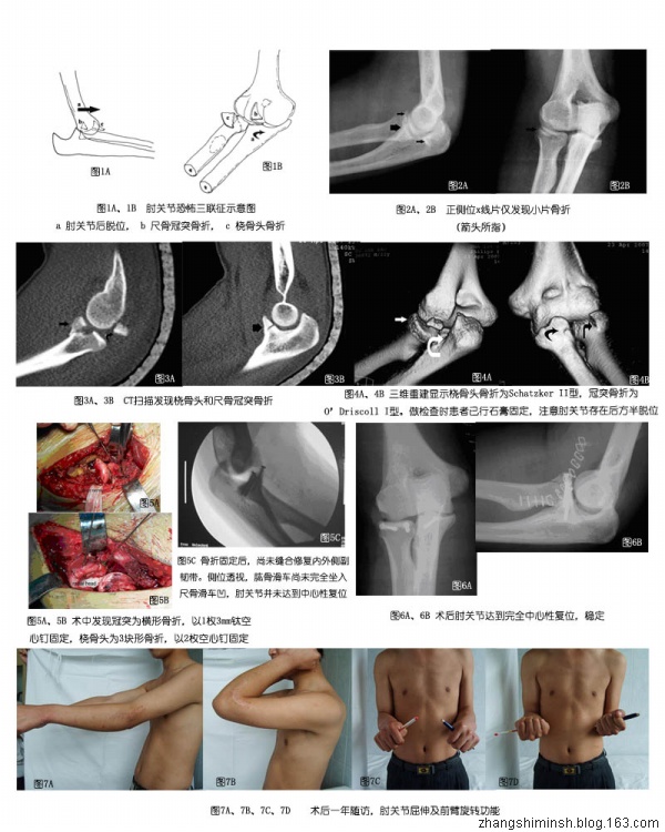 肘关节恐怖三联征