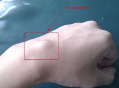 腱鞘囊肿的常见症状及治疗方法