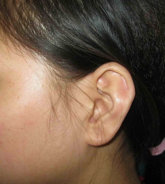 耳廓再造(病例图片) - 好大夫在线