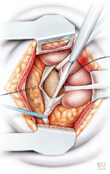 传统开放手术与微创手术治疗肾结石比较(图片) - 好大夫在线