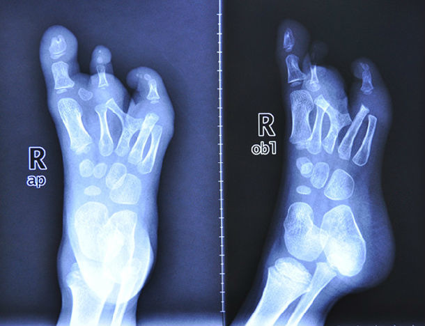 双足先天性畸形整形 - 好大夫在线