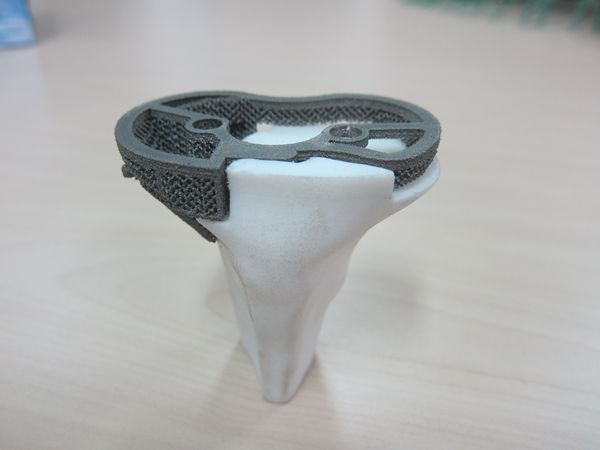 王韶进教授团队使用3d打印技术为患者打造钛合金膝关节 - 好大夫在线