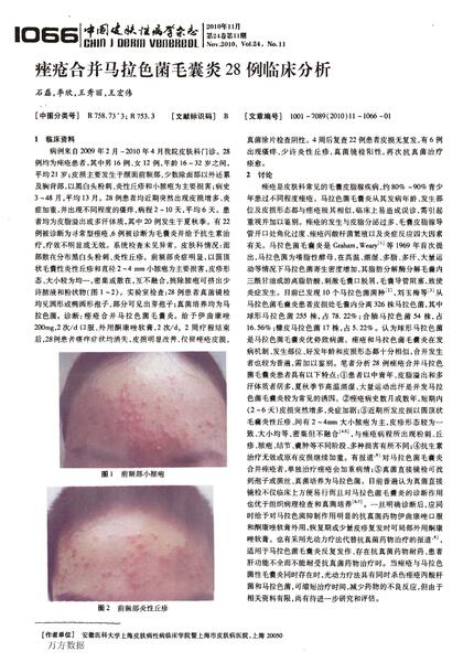 痤瘡合併馬拉色菌毛囊炎28例臨床分析