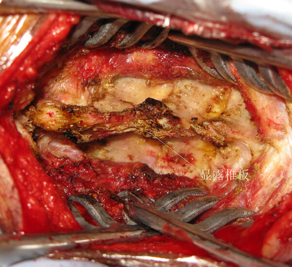 脊膜瘤手术成功率图片
