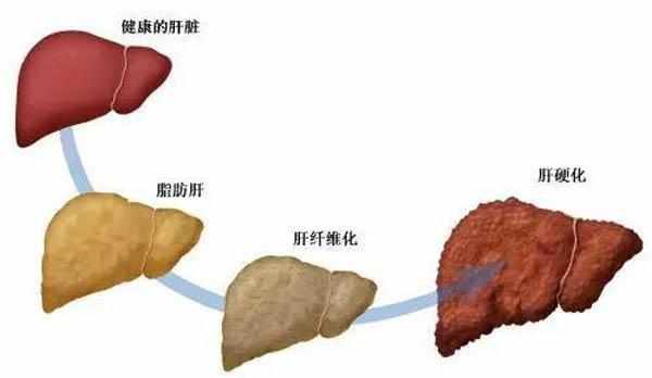 脂肪肝是怎么形成的?