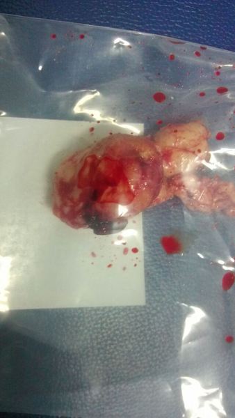 子宫肌瘤介入治疗术后,坏死脱落瘤体组织