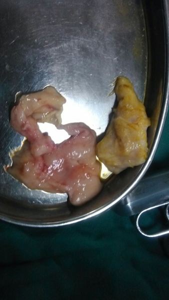 子宫肌瘤介入治疗术后,坏死脱落瘤体组织