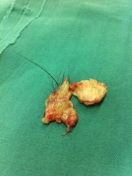 椎管内畸胎瘤图片