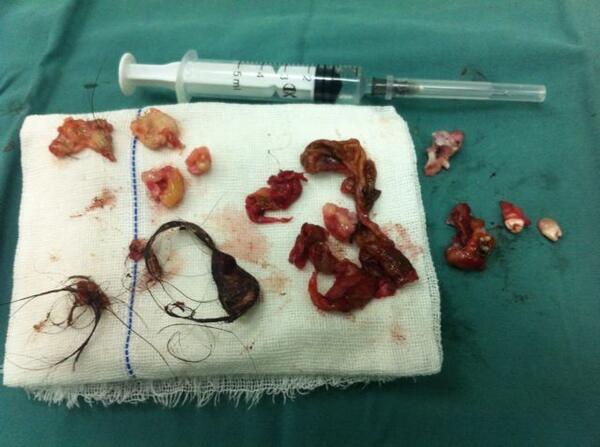 卵巢畸胎瘤手术图片