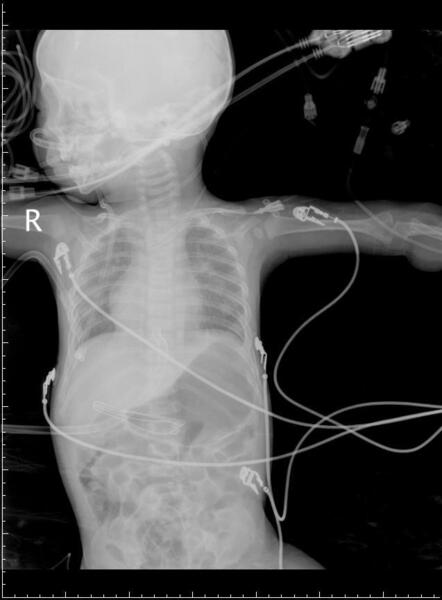 9月男婴 房缺室缺修补术+动脉导管结扎术