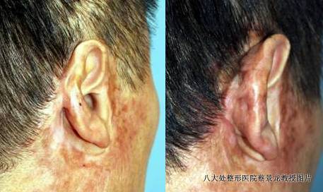 图6  女,10岁,下唇血管瘤治疗后凹陷,局部切除改形及皮肤磨削术治疗