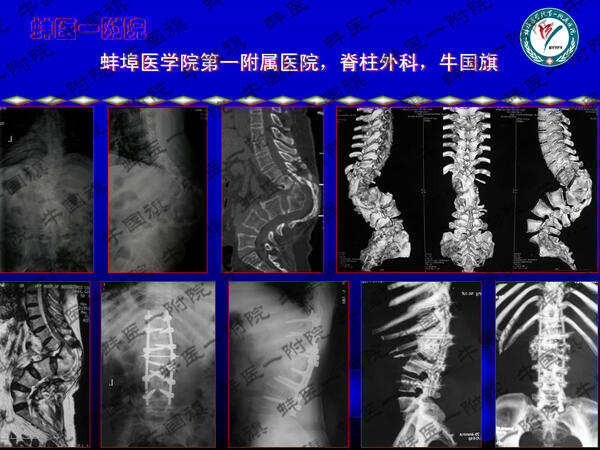 重度脊柱側後凸畸形vcr矯正術