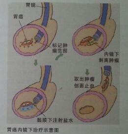胃镜检查的注意事项等,以及治疗方面如是否可以避免大手术来根治胃癌