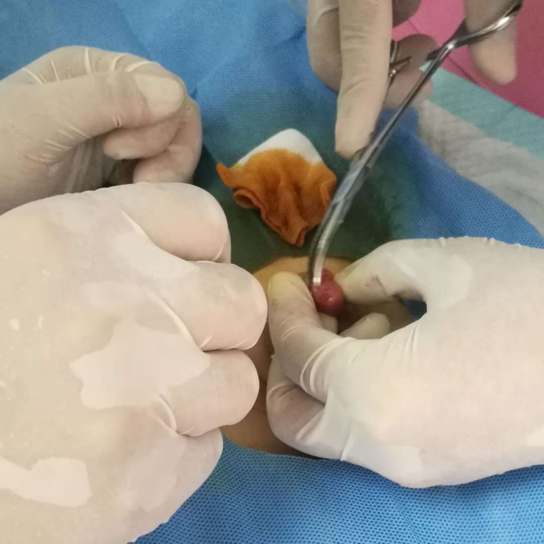 包茎手术感染化脓图片