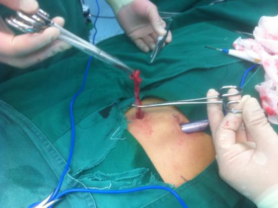 微创腹腔镜两孔法阑尾切除