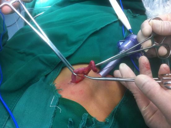 阑尾切除术 微创手术图片