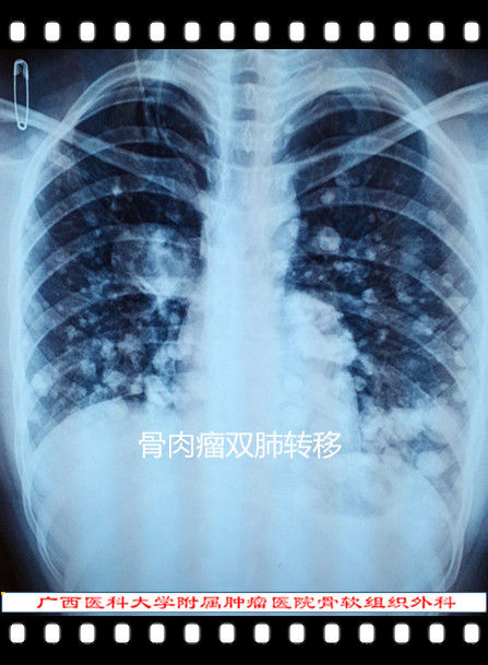 骨肿瘤治疗及各种影像学表现(图)