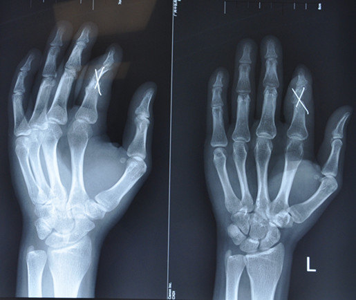 左手食指近侧指间关节陈旧性脱位畸形整形术 