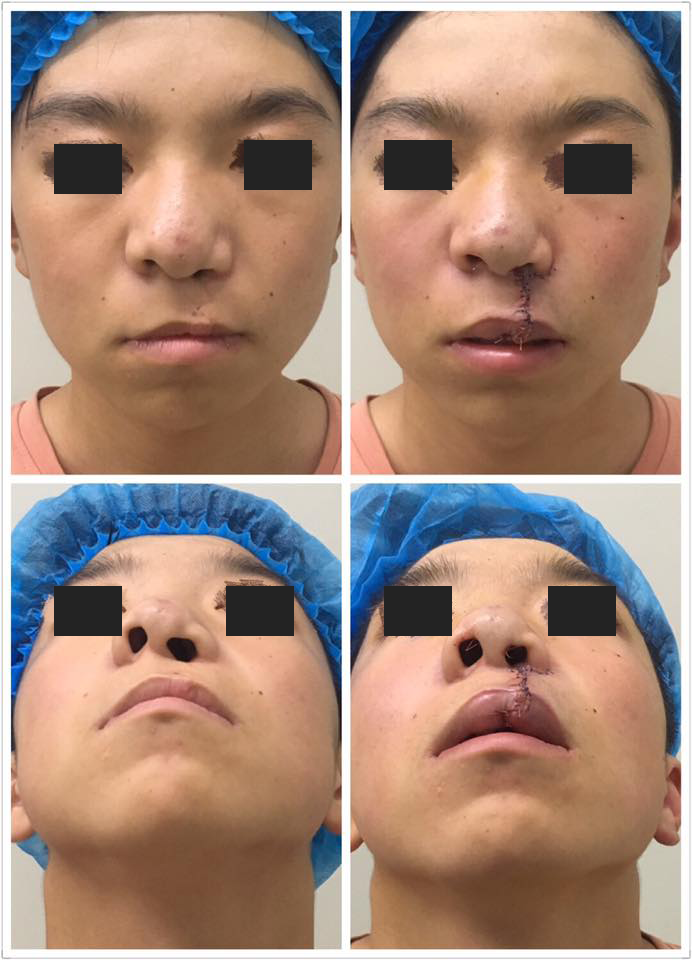 柴岗教授近期唇裂修复手术两例(3)