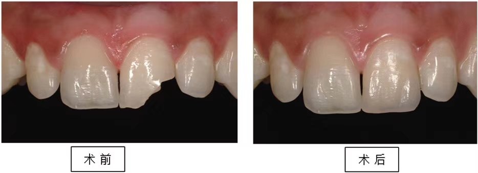【纳米材料补牙更逼真】