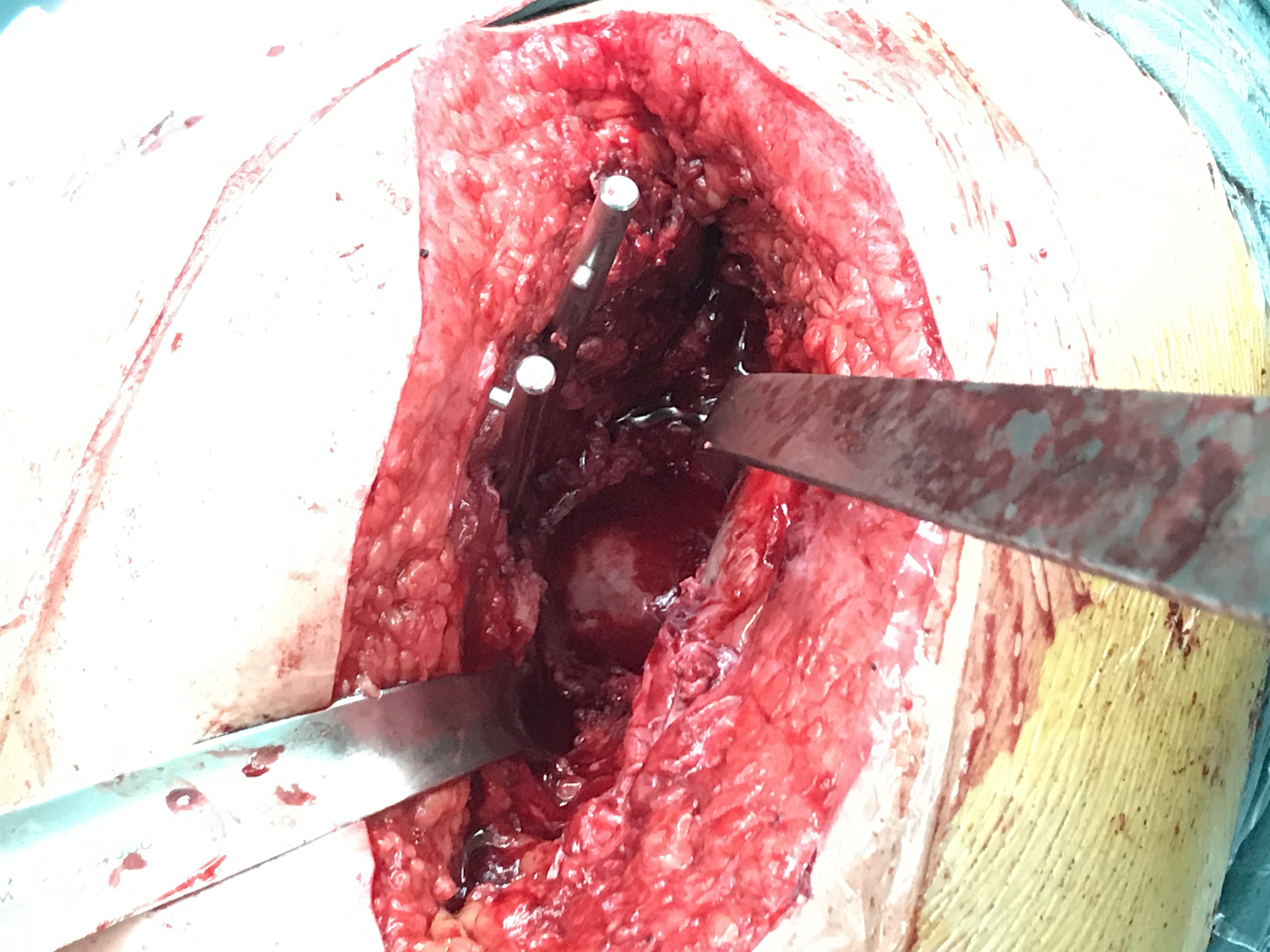 53岁女性,髋臼骨折,术后一年疼痛,人工全髋关节置换术.