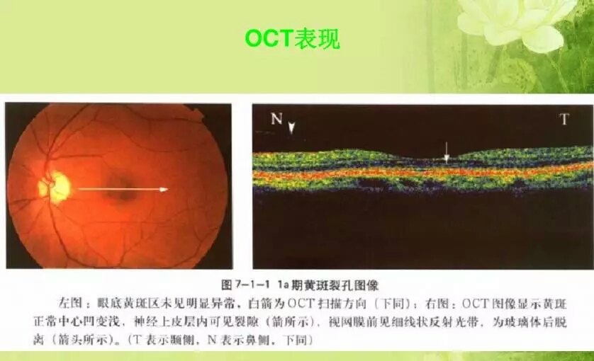 ppt学习:眼底病黄斑裂孔. - 好大夫在线